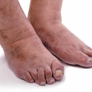 4 important things you need to know about rheumatoid arthritis