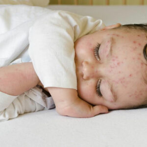 Here’s how to treat skin rashes in babies
