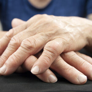 Rheumatoid Arthritis – Diagnosis and Treatment Options