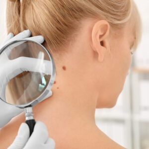 Worried About Skin Cancer Here’s What To Know