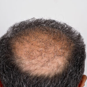 Hair Transplant – Types, Procedure, and Cost